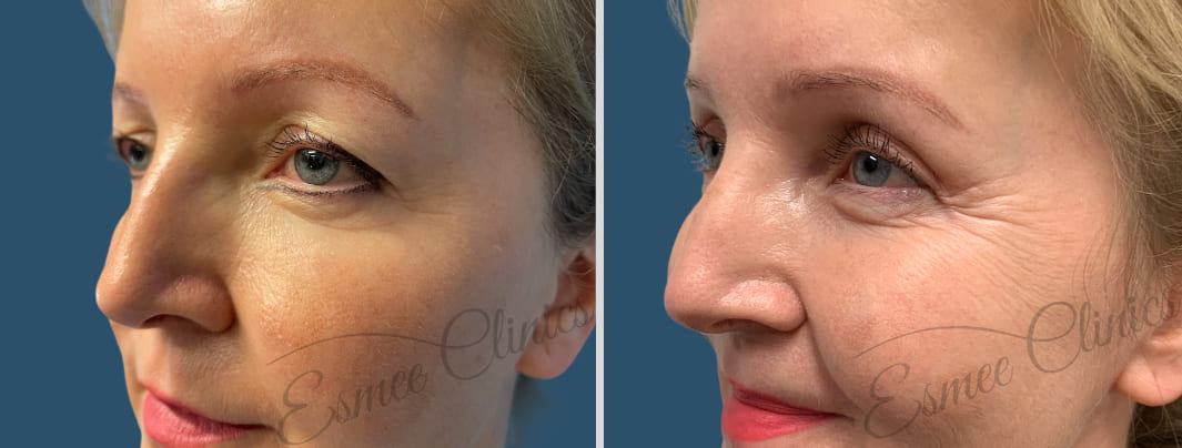 Before and After img